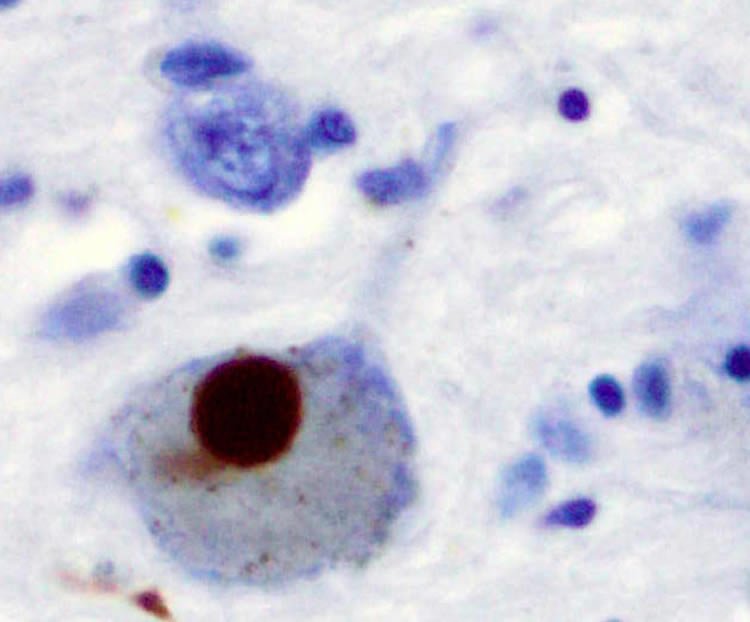 This image shows positive α-Synuclein staining of a Lewy body in a patient with Parkinson's disease.
