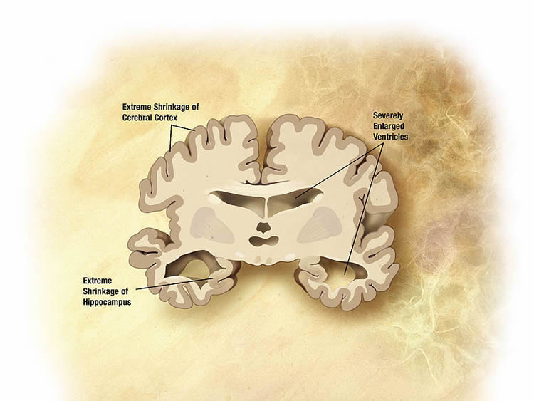 Image shows an alzheimer's brain slice.