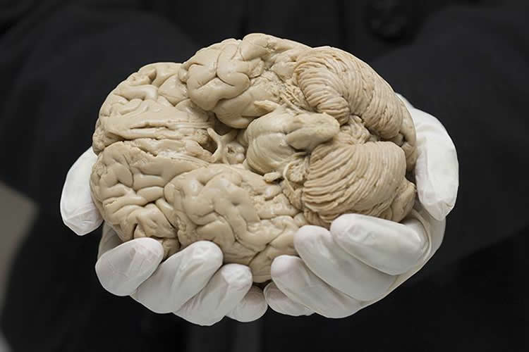 Image shows a brain of an Alzheimer's patient.