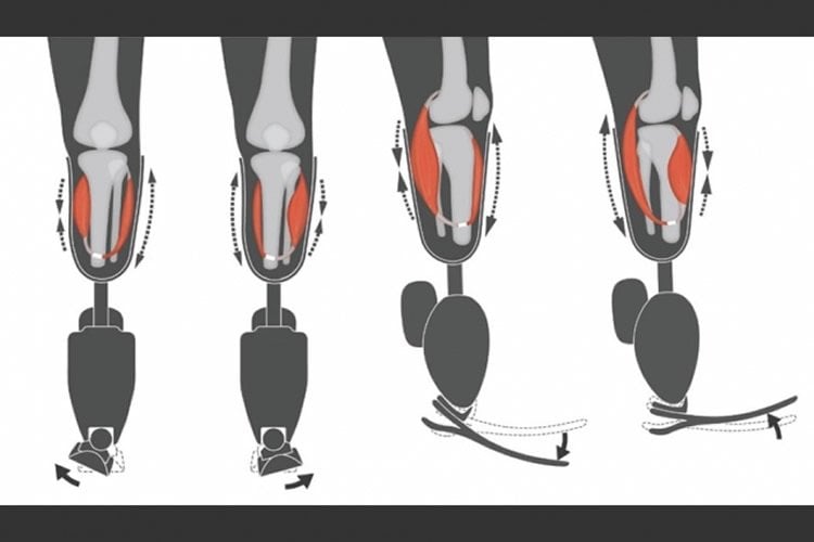 the prosthetic system