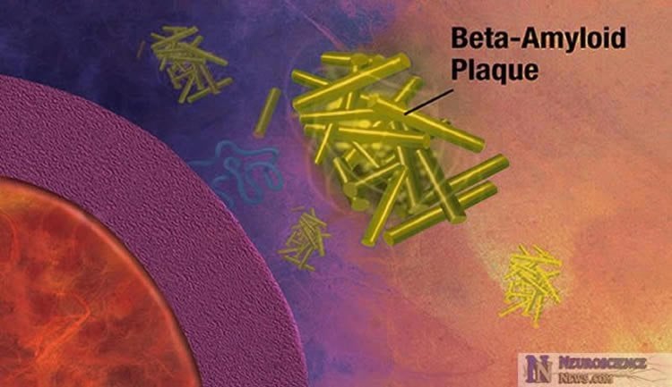 Diagram of amyloid beta plaques attacking a cell.