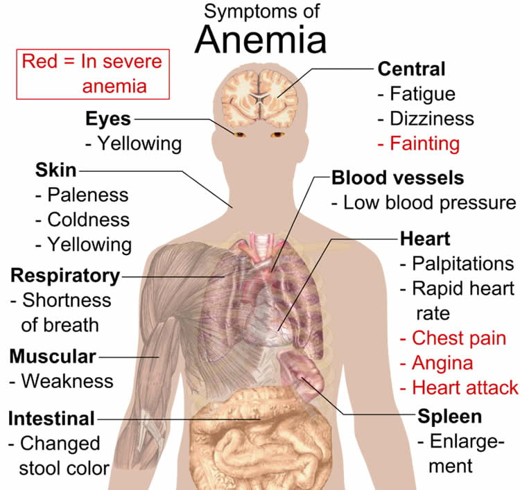 Image shows how anemia affects the body.