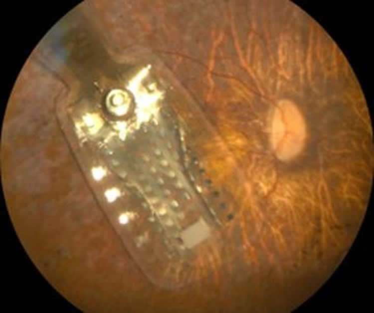 Image shows the Argus II Retinal 98 Prosthesis.