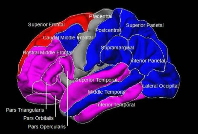 This is a brain scan with areas associated with bipolar disorder highlighted.