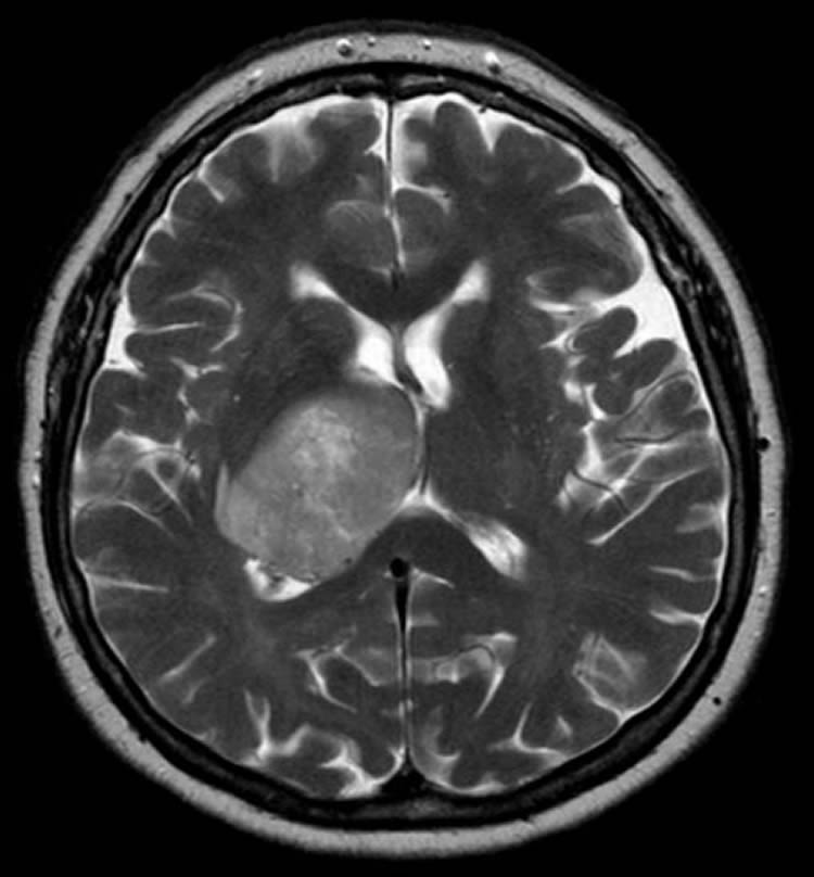 This image shows glioblastoma brain cancer from an MRI of a patient's head.