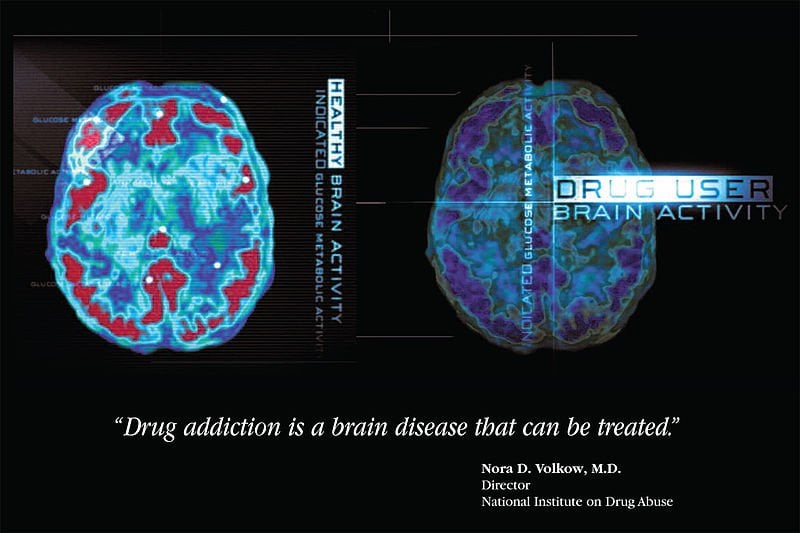 This image shows brain activity scans of a healthy person and one addicted to drugs.