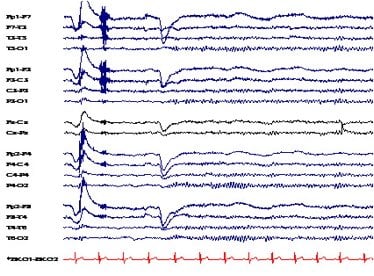 EEG trace patterns.