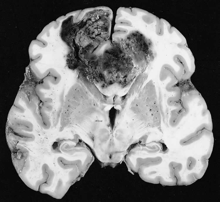 This image shows a brain slice with a glioblastoma tumor which is in the butterfly configuration.