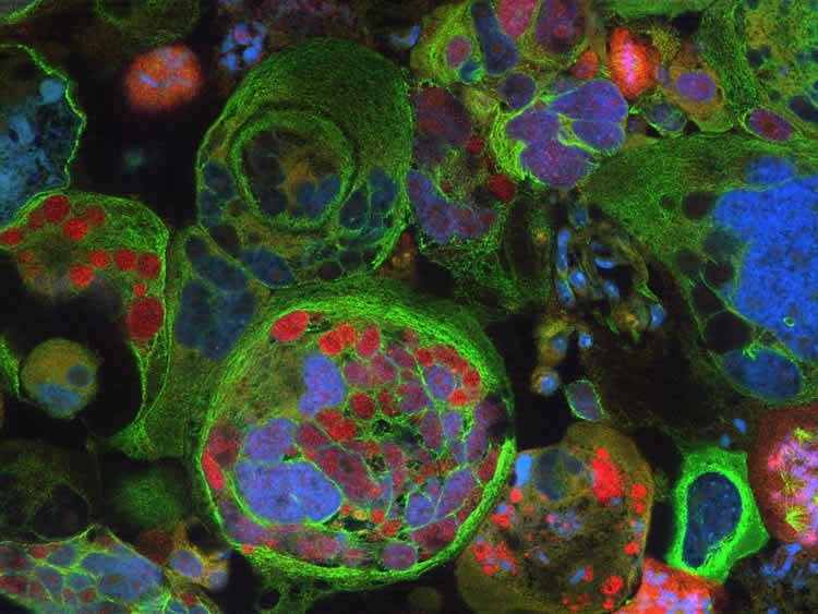 Image shows glioblastoma tumor cells.