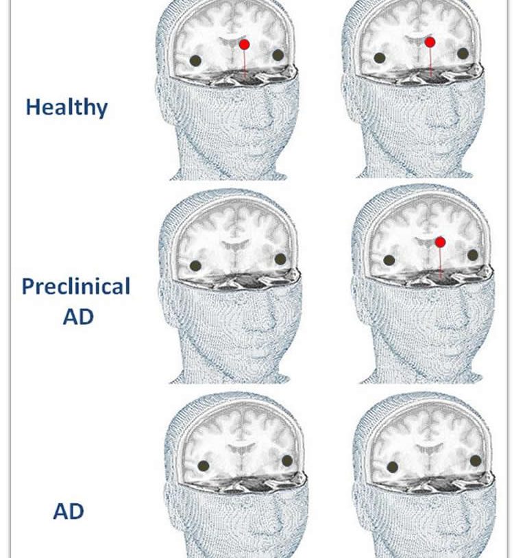 Image shows brain cutaways.