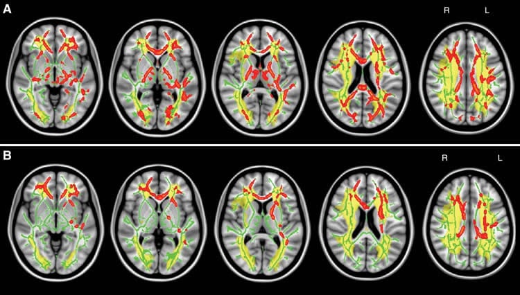 Image shows brain scans of white matter.